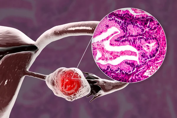 卵巢癌 显示左卵巢癌的三维图像和显示卵巢癌组织病理学的轻光镜 — 图库照片
