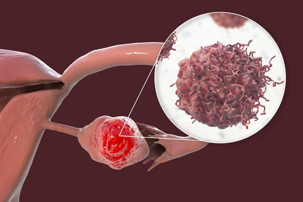 卵巢癌3D图像显示左侧卵巢恶性肿瘤及癌细胞特写 — 图库照片