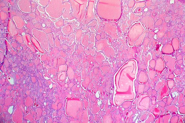 甲状腺の濾胞性腺腫 ライトマイクログラフ 甲状腺腺腫の組織病理学 顕微鏡下の写真 — ストック写真