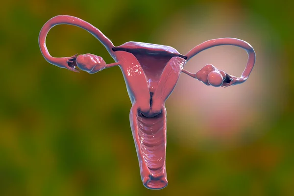Síndrome Ovario Poliquístico Ilustración Que Muestra Ovario Izquierdo Agrandado Con —  Fotos de Stock