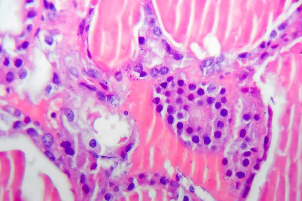 선천성 갑상선 마이크로 그래프 Thydoid Adenoma Histopathology 현미경으로 — 스톡 사진