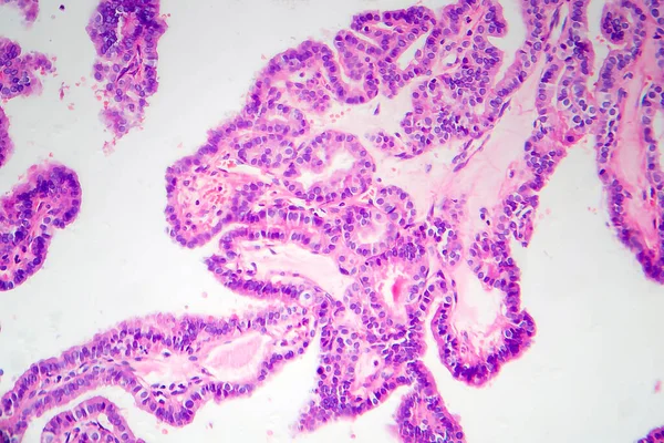 Carcinoma Papilar Tiroides Micrografía Ligera Foto Bajo Microscopio Tipo Más — Foto de Stock