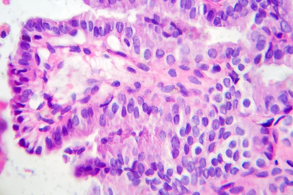 Carcinoma Papilífero Tiróide Micrografia Luz Foto Microscópio Tipo Mais Comum — Fotografia de Stock