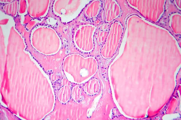 Folikulární Adenom Štítné Žlázy Světelný Mikrograf Histopatologie Adenomu Štítné Žlázy — Stock fotografie