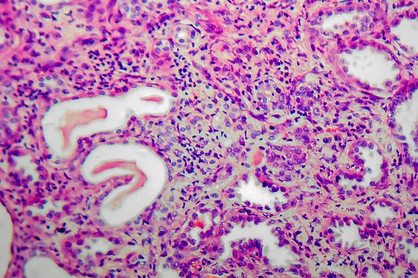Pielonefrite Crônica Microscópio Luz Foto Sob Microscópio — Fotografia de Stock