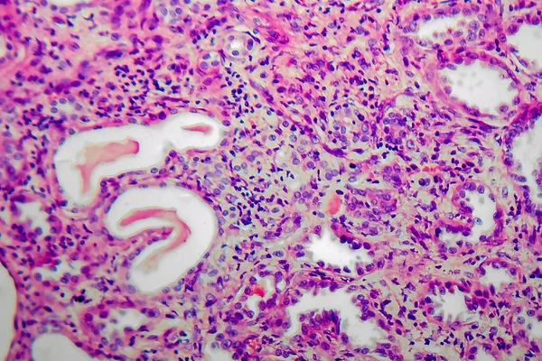 Pyelonefritis Crónica Micrografía Ligera Foto Microscopio — Foto de Stock