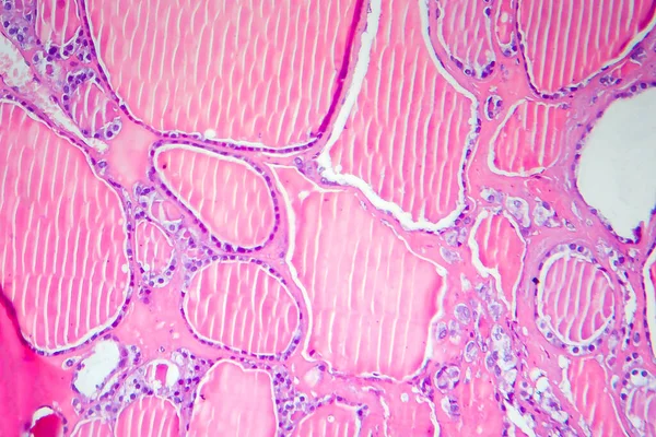 Folikulární Adenom Štítné Žlázy Světelný Mikrograf Histopatologie Adenomu Štítné Žlázy — Stock fotografie
