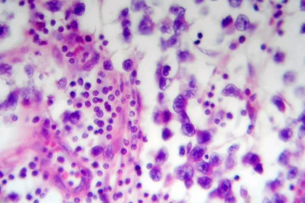 Séminome Testiculaire Micrographie Photonique Photo Microscope Une Tumeur Commune Des — Photo