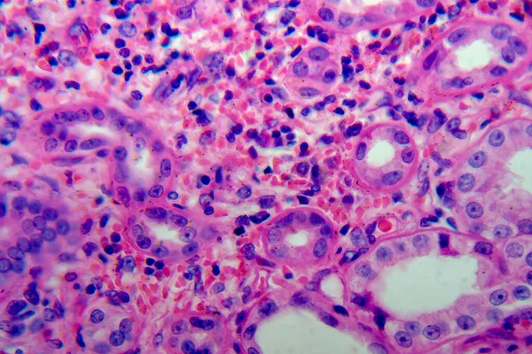 Χρόνια Πυελονεφρίτιδα Μικρογραφία Φωτός Φωτογραφία Στο Μικροσκόπιο — Φωτογραφία Αρχείου