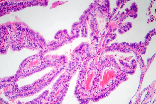 Papillary Thyroid Carcinoma Light Micrograph Photo Microscope Most Common Type — Stock Photo, Image