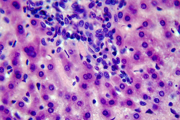 Coccidiosis Coccidia Hígado Micrografía Ligera Foto Bajo Microscopio — Foto de Stock