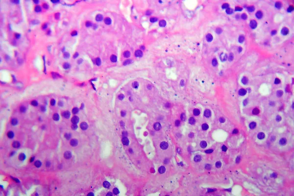 선천성 갑상선 마이크로 그래프 Thydoid Adenoma Histopathology 현미경으로 — 스톡 사진