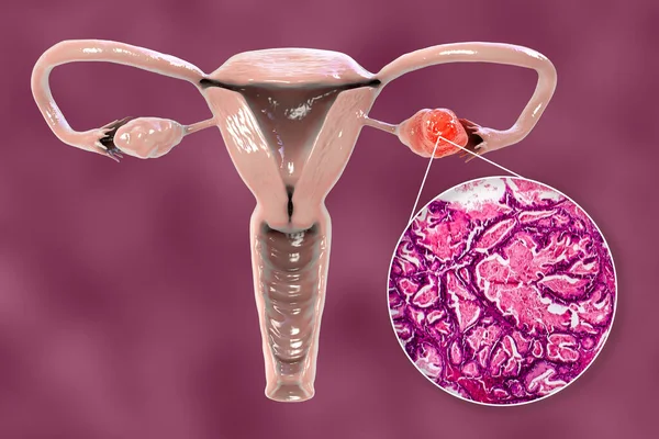 Ovarian cancer, 3D illustration showing malignant tumor in the left ovary and light photomicrograph showing histopathology of ovarian cancer