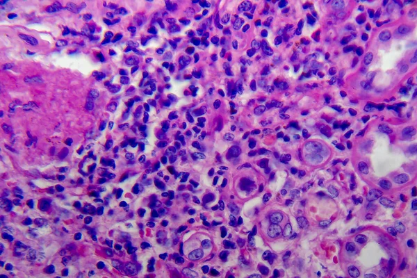 Χρόνια Πυελονεφρίτιδα Μικρογραφία Φωτός Φωτογραφία Στο Μικροσκόπιο — Φωτογραφία Αρχείου