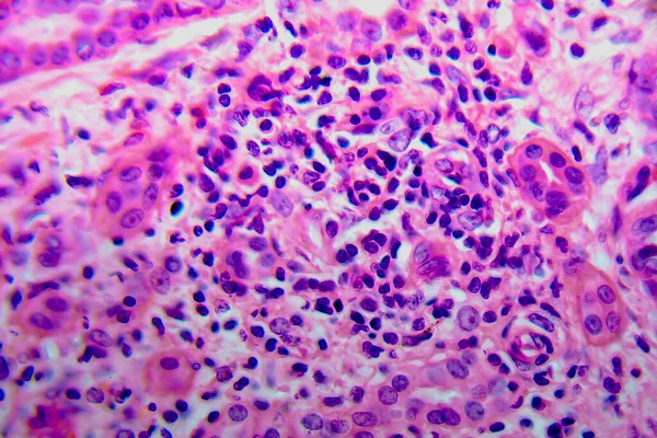 Chronická Pyelonefritida Světelný Mikrograf Fotografie Pod Mikroskopem — Stock fotografie