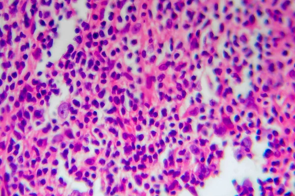 Hodgkin lymphoma, light micrograph, photo under microscope. It is a type of lymphoma, in which cancer originates from lymphocytes
