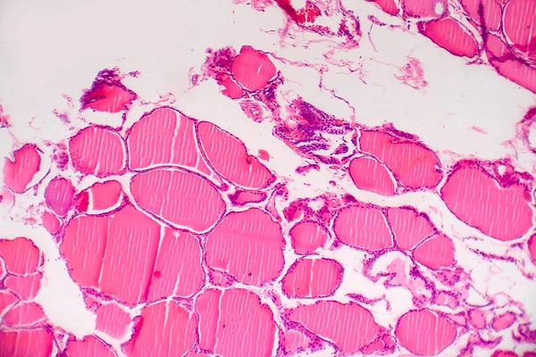 Cáncer Tiroides Micrografía Ligera Foto Bajo Microscopio —  Fotos de Stock