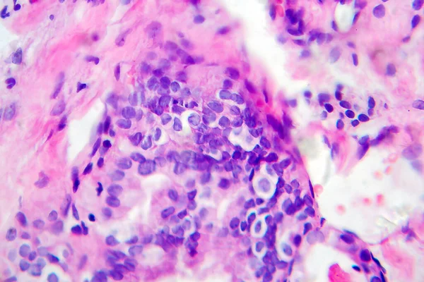 Carcinoma Papilar Tiroides Micrografía Ligera Foto Bajo Microscopio Tipo Más — Foto de Stock