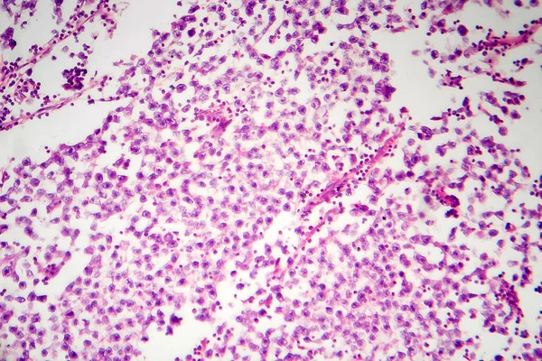精巣セミノーマ 光マイクログラフ 顕微鏡下の写真 検査の最も一般的な生殖細胞腫瘍 — ストック写真
