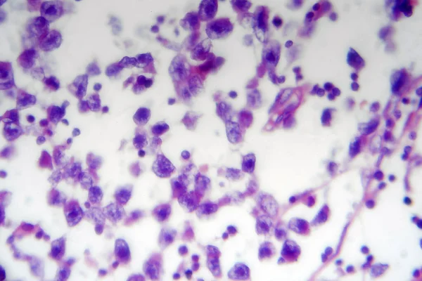Seminoma Testicular Micrografía Ligera Foto Bajo Microscopio Tumor Células Germinativas —  Fotos de Stock