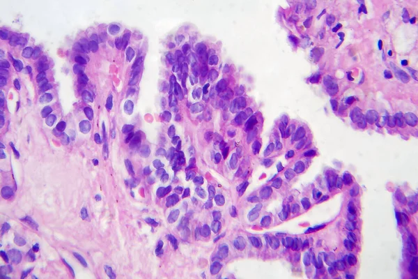 Carcinoma Papilar Tiroides Micrografía Ligera Foto Bajo Microscopio Tipo Más — Foto de Stock