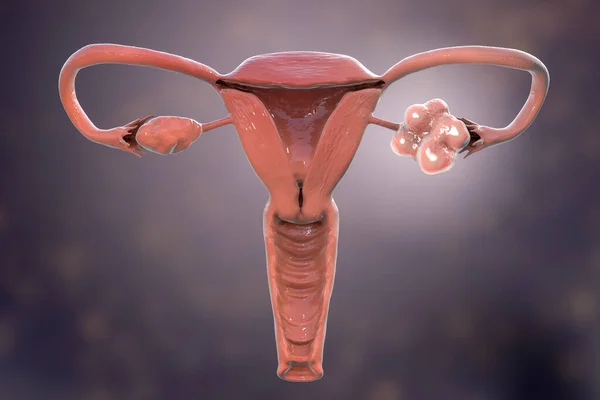 多囊性卵巢综合征 显示健康卵巢 和囊肿扩大卵巢 的三维图像 — 图库照片