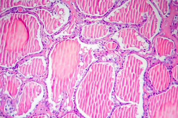 Adenoma Folicular Glándula Tiroides Micrografía Ligera Histopatología Del Adenoma Tidoide —  Fotos de Stock