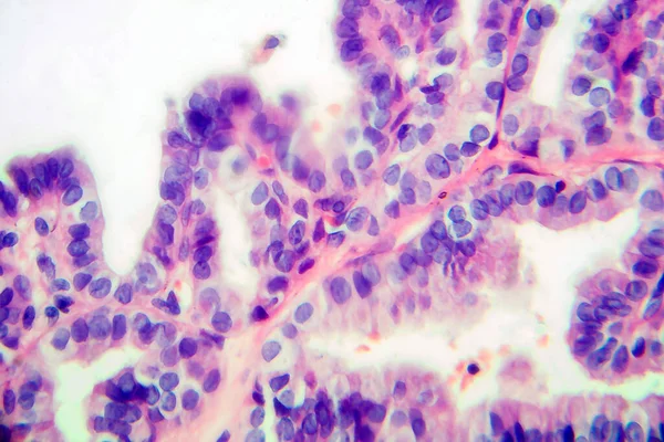 Carcinoma Papilar Tiroides Micrografía Ligera Foto Bajo Microscopio Tipo Más — Foto de Stock