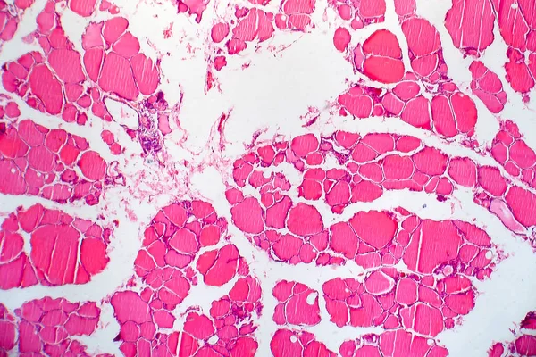 Rakovina Štítné Žlázy Světelný Mikrograf Fotografie Pod Mikroskopem — Stock fotografie