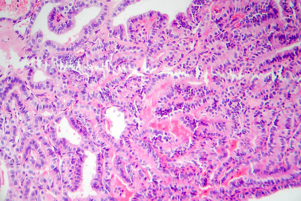 Папиллярная опухоль щитовидной железы, световой микрограф, фото под микроскопом. Наиболее распространенный тип рака щитовидной железы