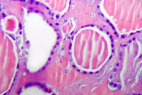 Adenoma Folicular Glándula Tiroides Micrografía Ligera Histopatología Del Adenoma Tidoide — Foto de Stock