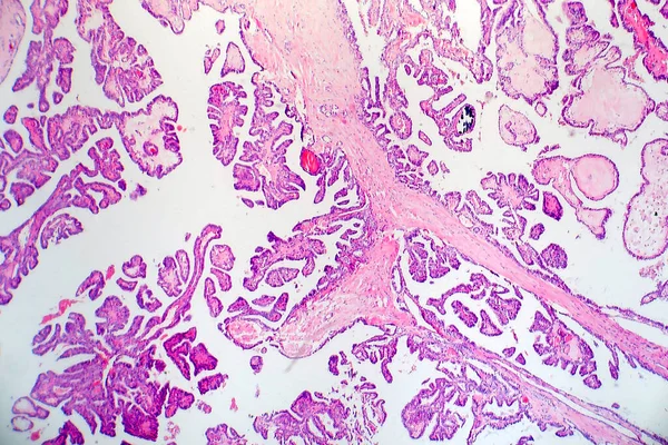 Papillary thyroid carcinoma, light micrograph, photo under microscope. The most common type of thyroid cancer