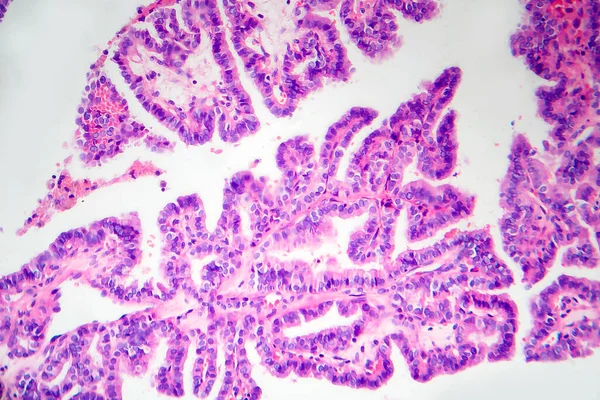 乳頭甲状腺がん 軽いマイクログラフ 顕微鏡下の写真 甲状腺がんの中で最も一般的なタイプは — ストック写真