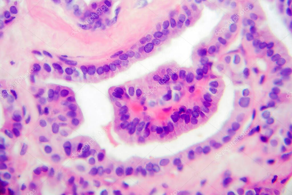 Papillary thyroid carcinoma, light micrograph, photo under microscope. The most common type of thyroid cancer