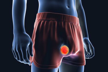Testis kanseri, testis semineri, koriyokarsinom, teratom ya da testislerin diğer tümörleri, 3 boyutlu illüstrasyon