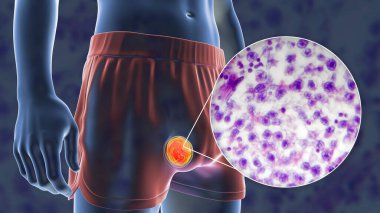 Testis kanseri, testis semineri, tıbbi 3 boyutlu illüstrasyon ve ışık mikrografı. Testisin kötü huylu tümörü