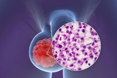 Testis kanseri, testis semineri, tıbbi 3 boyutlu illüstrasyon ve ışık mikrografı. Testisin kötü huylu tümörü