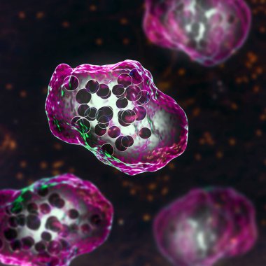 Kızamık hastalığı, biyopsi örneklerinin mikroskopisi sırasında görülen dev çok çekirdekli hücreler, Warthin-Finkeldey dev hücreleri olarak bilinen, 3D çizimler. Ayrıca HIV virüslü hastalarda, Kimura hastalıklarında da görülür.