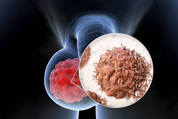 Testicular cancer, medical 3D illustration showing malignant tumor in the testis and close-up view of testicular cancer cell