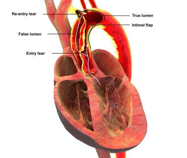 Yükselen aort disekliği, 3 boyutlu illüstrasyon. Hayati tehlike arz eden kardiyovasküler bir acil durum olan yükselen aortunda yırtık ve sahte lümen oluşumu gösteriyor..