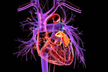 Sol kalp başakçığı (kırmızı), 3 boyutlu illüstrasyon. Kulakçık, sol atriyumun küçük bir kas torbasıdır. Atriyal fibrilasyonda trombüs oluşumu ve felç riski açısından klinik açıdan önemlidir..