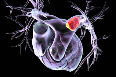 Sol akciğer embolisi, 3 boyutlu illüstrasyon. Sol akciğer atardamarında pıhtı sol akciğerde kan akışını engelliyor..
