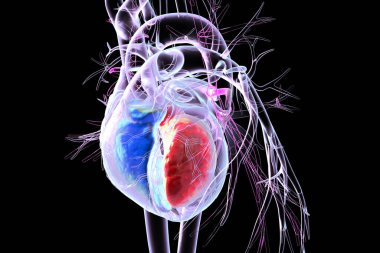 Kalp karıncığındaki delikler, üç boyutlu çizimler. Sağ ventrikül mavi ve sol ventrikül kırmızıda görünüyor, bu da kalp anatomisini gösteriyor..