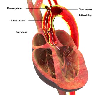 Yükselen aort disekliği, 3 boyutlu illüstrasyon. Hayati tehlike arz eden kardiyovasküler bir acil durum olan yükselen aortunda yırtık ve sahte lümen oluşumu gösteriyor..