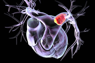 Sol akciğer embolisi, 3 boyutlu illüstrasyon. Sol akciğer atardamarında pıhtı sol akciğerde kan akışını engelliyor..