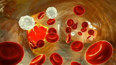 Sağ akciğer embolisi, 3 boyutlu illüstrasyon, akciğer gövdesi içinde. Trrombus sağ akciğer atardamarını tıkıyor, sağ akciğere kan akışını azaltıyor, hipoksiye ve akut akciğer hipertansiyonuna neden oluyor..