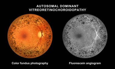 Otozomal baskın vitreoretinokoroidopati, illüstrasyon renk fundus ve florasan anjiyo görüntüsünü periferik retina atrofisi, pigmenter değişimleri ve anormal koroidal floresans göstermektedir..