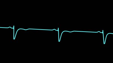 V1-V2 'deki normal ECG, 3 boyutlu illüstrasyon sinüs ritmini gösteriyor. Beklenen küçük R dalgaları ve sağ ön kordiyalde derin S dalgaları var..