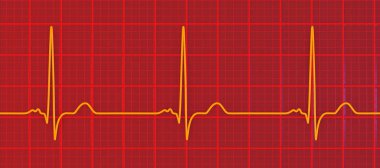 P-mitrale, 3D illüstrasyon sol atriyal iletim gecikmesiyle uyumlu geniş, çentik P dalgalarıyla EKG gösteriyor.