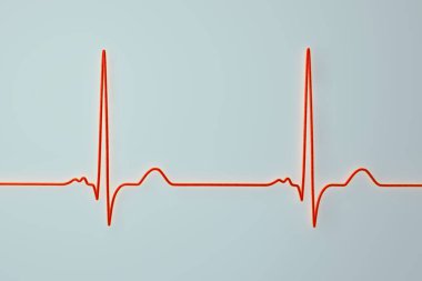 P-mitrale, 3D illüstrasyon sol atriyal iletim gecikmesiyle uyumlu geniş, çentik P dalgalarıyla EKG gösteriyor.